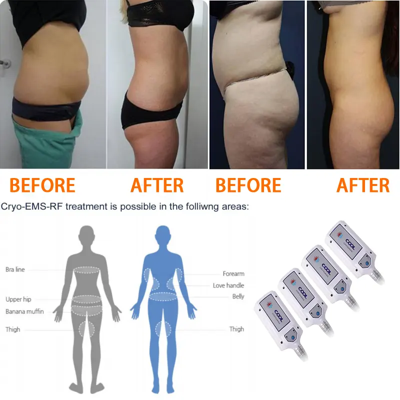 Professional Cryolipolysis Freeze Shape Cryo+EMS+RFfor Fat Reduction, Firming & Lymphatic Drainage Tightening & Sculpting