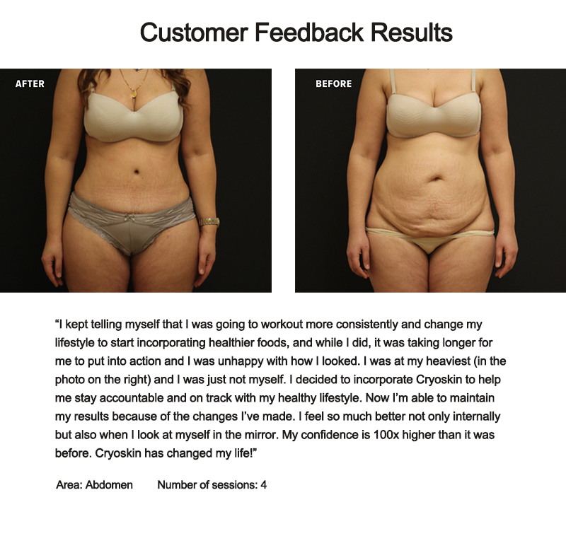 Cryoskin C9 Cryo Thermal Shock + EMS Body Sculpting Machine for Fat Loss, Cellulite, and Skin Tightening