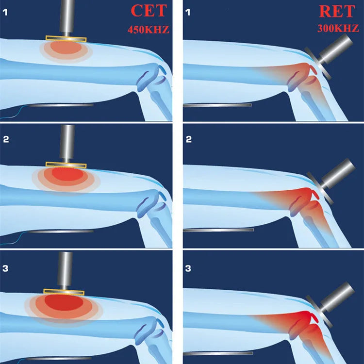Máquina de diatermia adelgazante con radiofrecuencia monopolar CET RET de 448 K para el cuidado corporal y el calentamiento profundo, terapia muscular Tecar RF y fisioterapia.